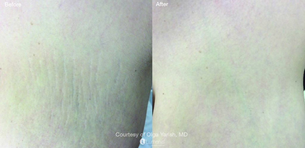 Textural Treatment stretchmarks