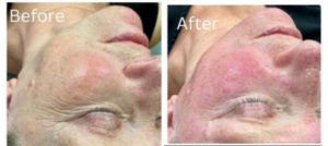 Vivace RF 3 Vivace Before & After Image | Rejuvenation Center | Wheeling, WV