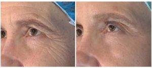 Vivace RF 4 Vivace Before & After Image | Rejuvenation Center | Wheeling, WV