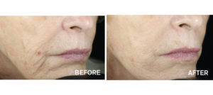 Vivace RF 5 Vivace Before & After Image | Rejuvenation Center | Wheeling, WV
