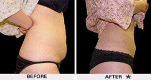 rejuvenation sculpt