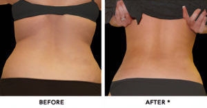 smartlipo32.edited
