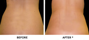 smartlipo39.edited