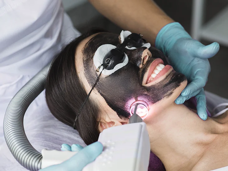 Laser Carbon Peel