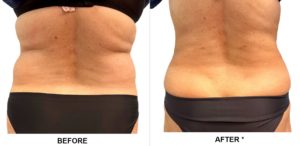 Safesculpt Before After